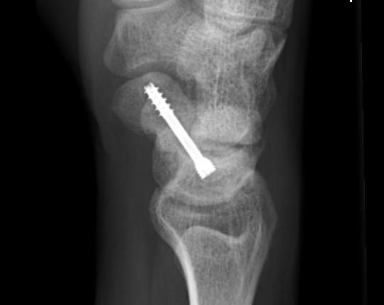 Scaphoid ORIF Proximal Pole Lateral